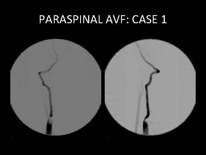 PARASPINAL AVF: CASE 1 PARASPINAL AVF: CASE 1