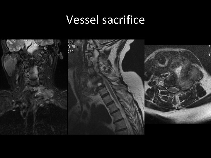 Vessel sacrifice Vessel sacrifice