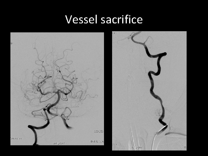 Vessel sacrifice Vessel sacrifice