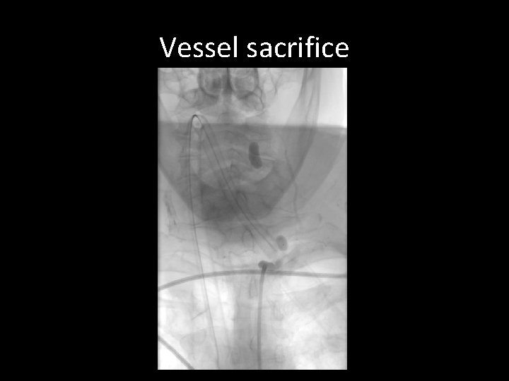 Vessel sacrifice Vessel sacrifice