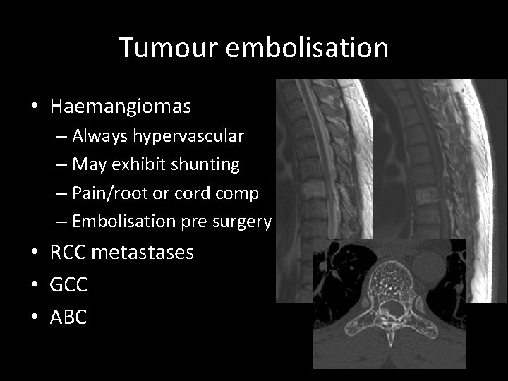 Tumour embolisation • Haemangiomas – Always hypervascular – May exhibit shunting – Pain/root or Tumour embolisation • Haemangiomas – Always hypervascular – May exhibit shunting – Pain/root or