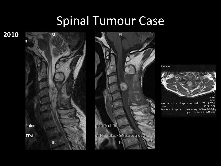 Spinal Tumour Case 2010 Spinal Tumour Case 2010
