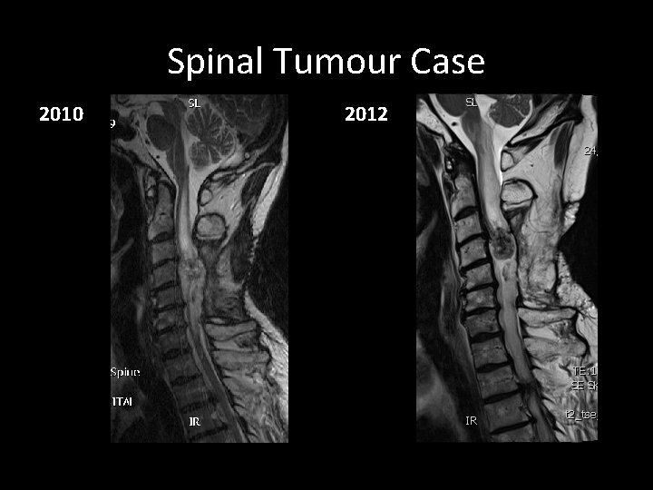 Spinal Tumour Case 2010 2012 Spinal Tumour Case 2010 2012