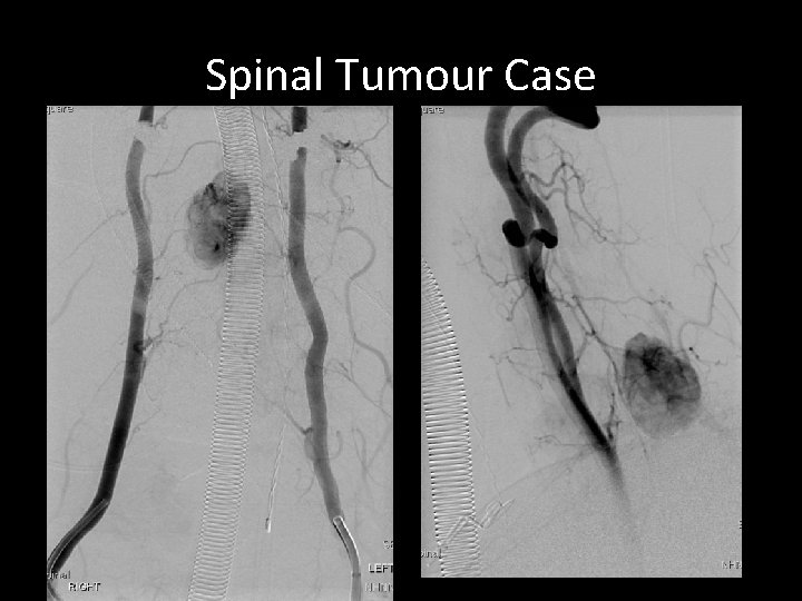 Spinal Tumour Case Spinal Tumour Case