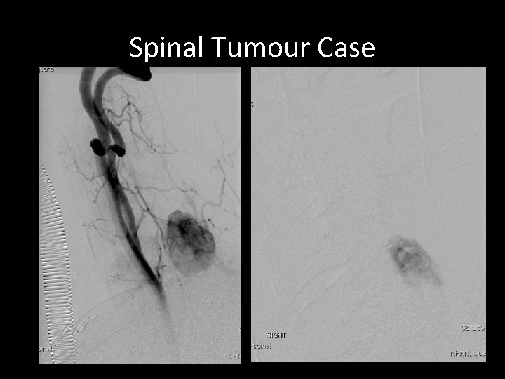 Spinal Tumour Case Spinal Tumour Case