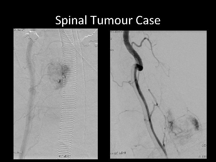 Spinal Tumour Case Spinal Tumour Case