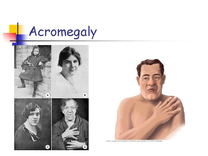 Acromegaly 