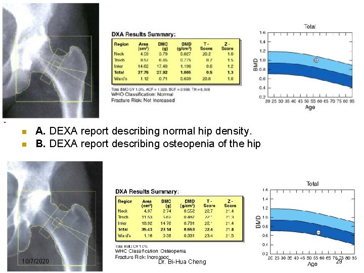 n n A. DEXA report describing normal hip density. B. DEXA report describing osteopenia