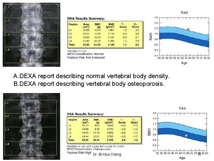 A. DEXA report describing normal vertebral body density. B. DEXA report describing vertebral body