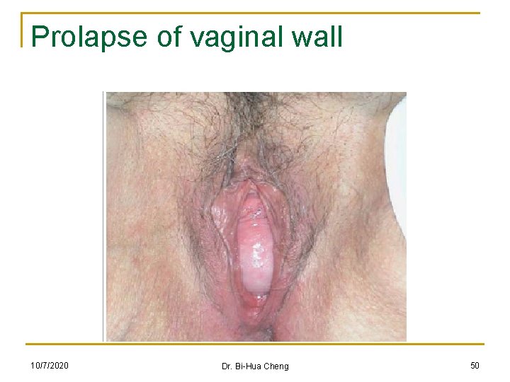 Prolapse of vaginal wall 10/7/2020 Dr. Bi-Hua Cheng 50 