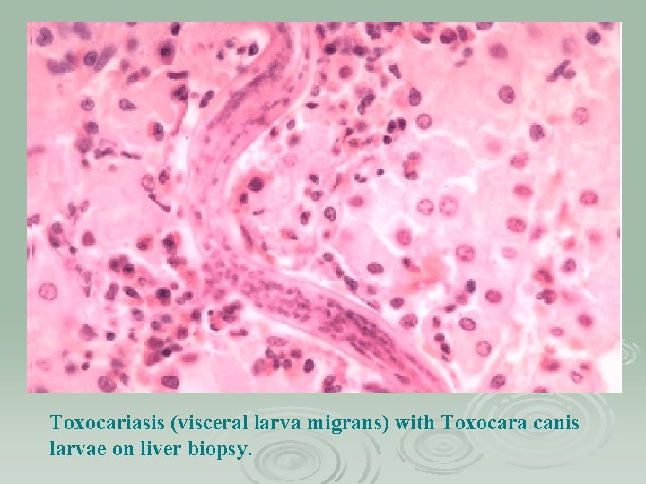 Toxocariasis (visceral larva migrans) with Toxocara canis larvae on liver biopsy. 