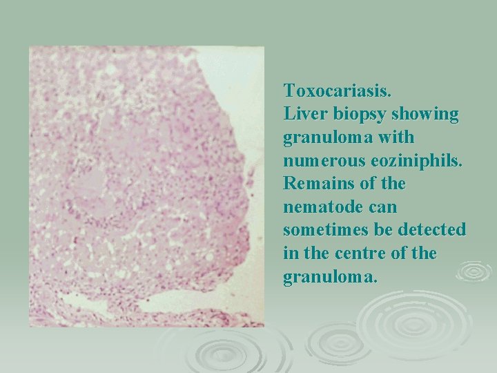 Toxocariasis. Liver biopsy showing granuloma with numerous eoziniphils. Remains of the nematode can sometimes