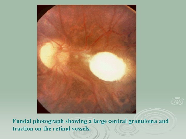Fundal photograph showing a large central granuloma and traction on the retinal vessels. 
