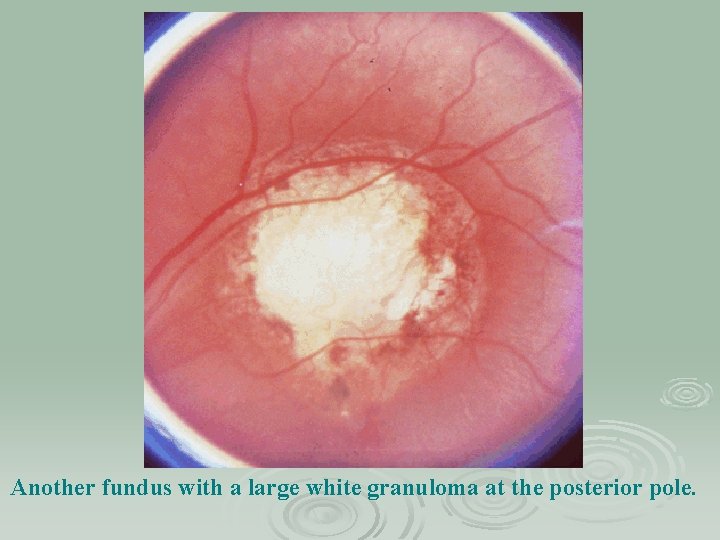Another fundus with a large white granuloma at the posterior pole. 