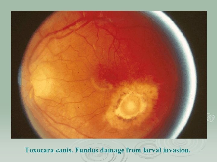Toxocara canis. Fundus damage from larval invasion. 