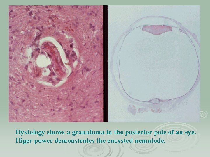 Hystology shows a granuloma in the posterior pole of an eye. Higer power demonstrates