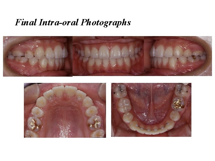 Final Intra-oral Photographs 