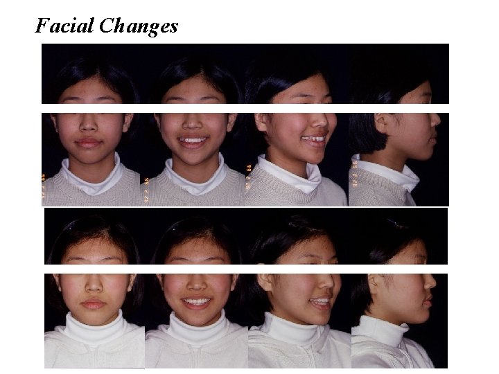 Facial Changes 