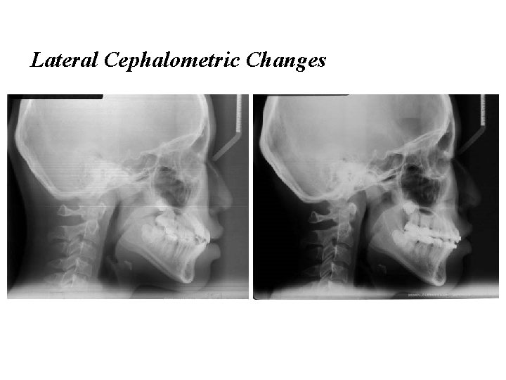 Lateral Cephalometric Changes 