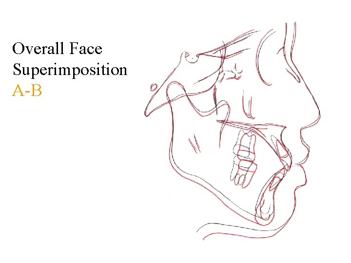 Overall Face Superimposition A-B 