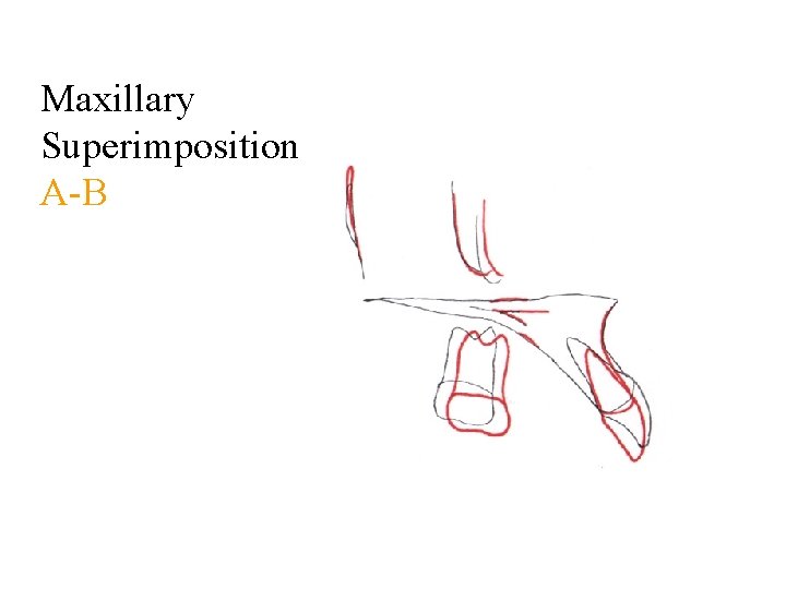 Maxillary Superimposition A-B 