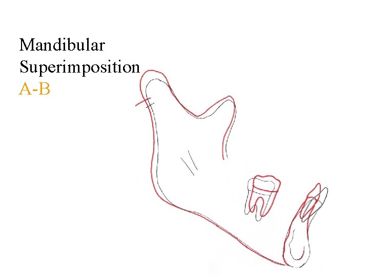 Mandibular Superimposition A-B 