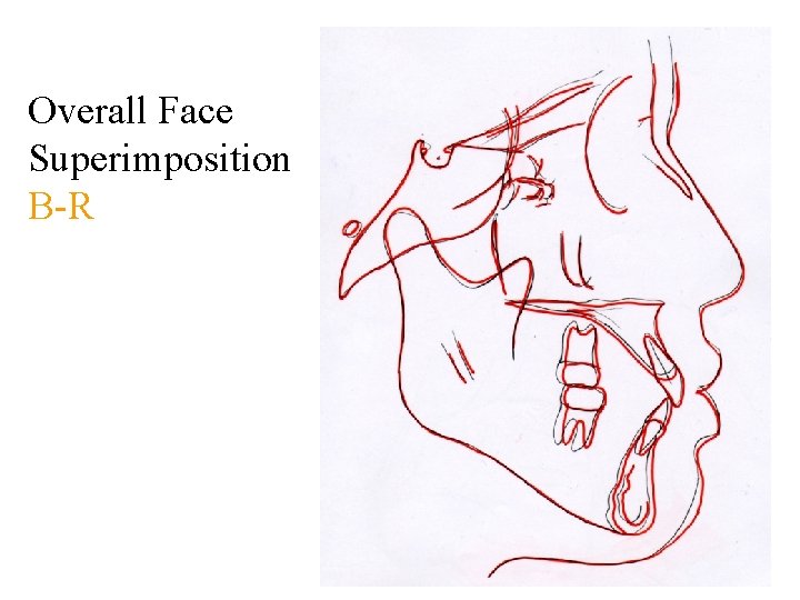 Overall Face Superimposition B-R 