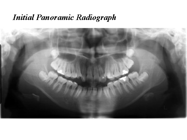 Initial Panoramic Radiograph 