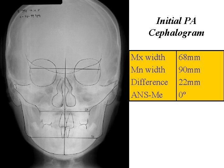 Initial PA Cephalogram Mx width Mn width Difference ANS-Me 68 mm 90 mm 22