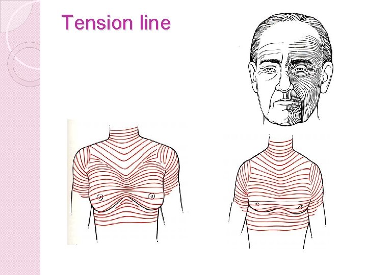 Tension line 