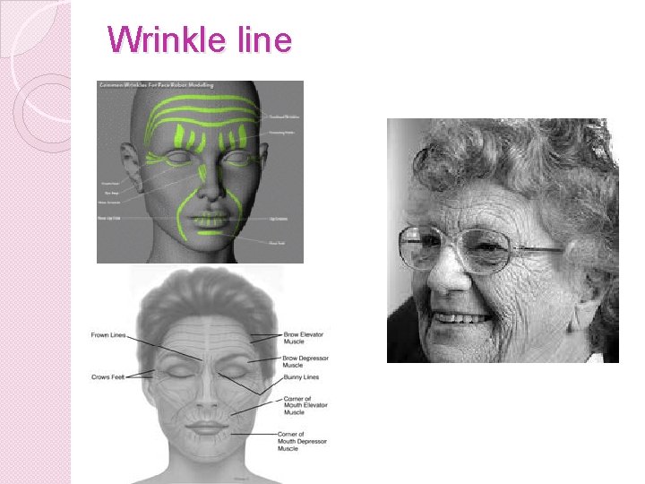 Wrinkle line 