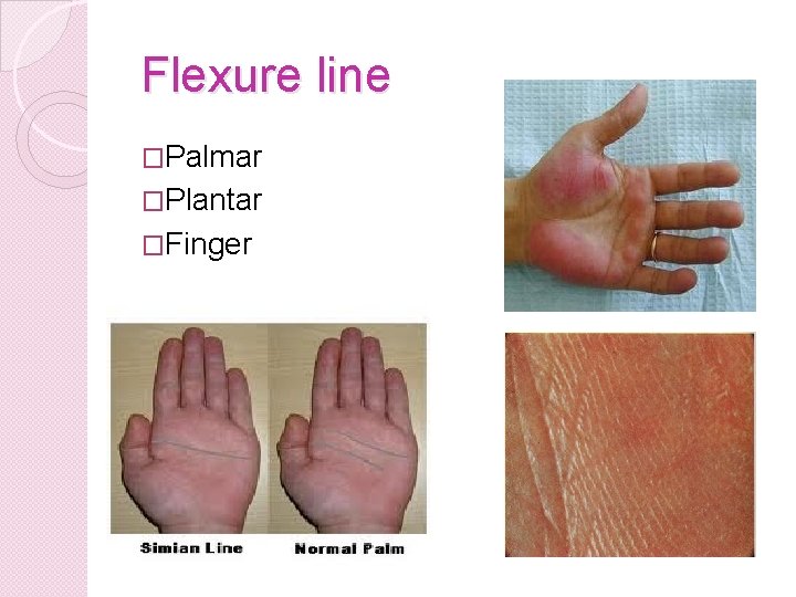 Flexure line �Palmar �Plantar �Finger 