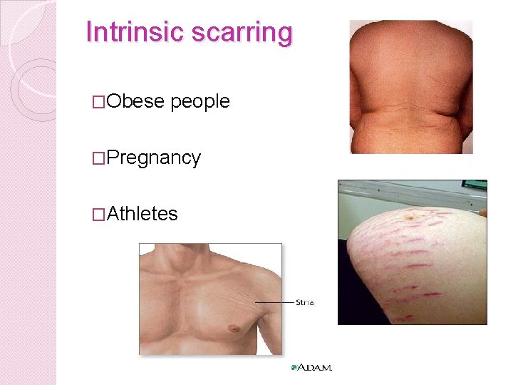 Intrinsic scarring �Obese people �Pregnancy �Athletes 
