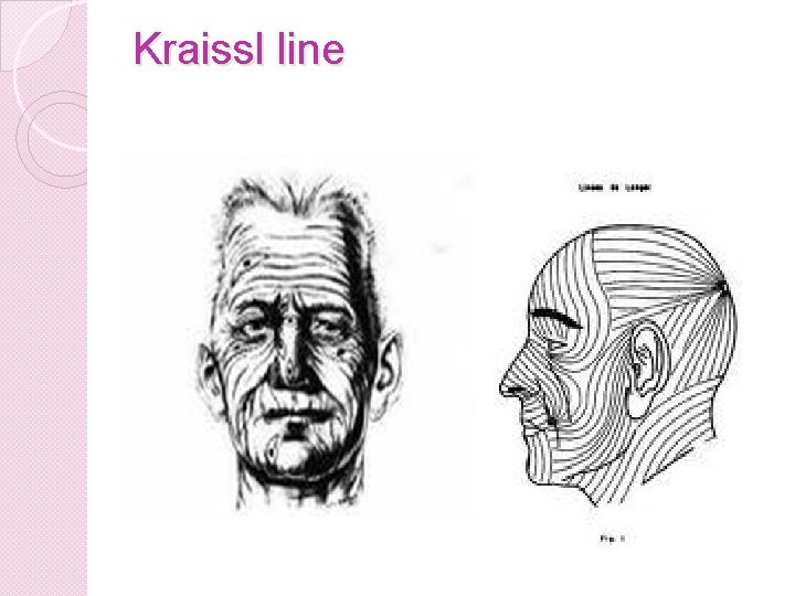 Kraissl line 