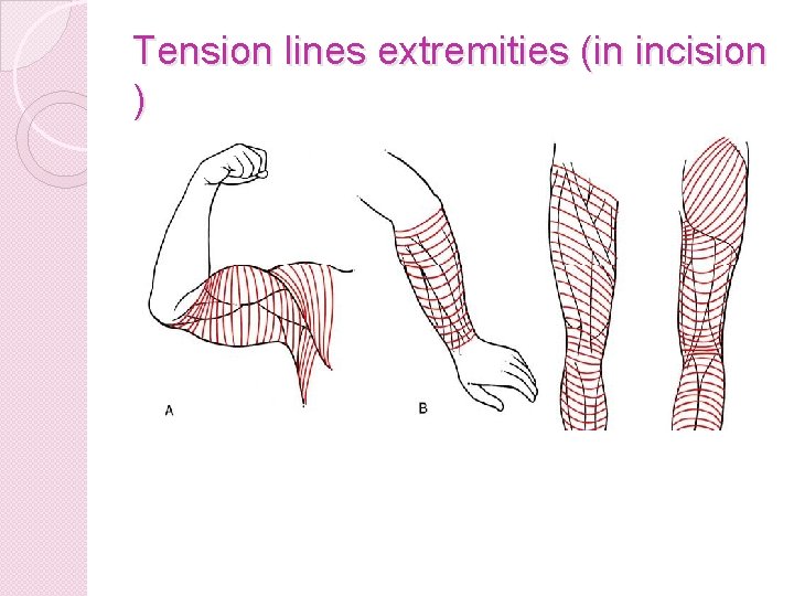 Tension lines extremities (in incision ) 