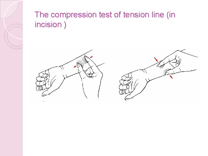 The compression test of tension line (in incision ) 