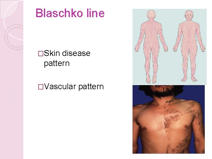 Blaschko line �Skin disease pattern �Vascular pattern 
