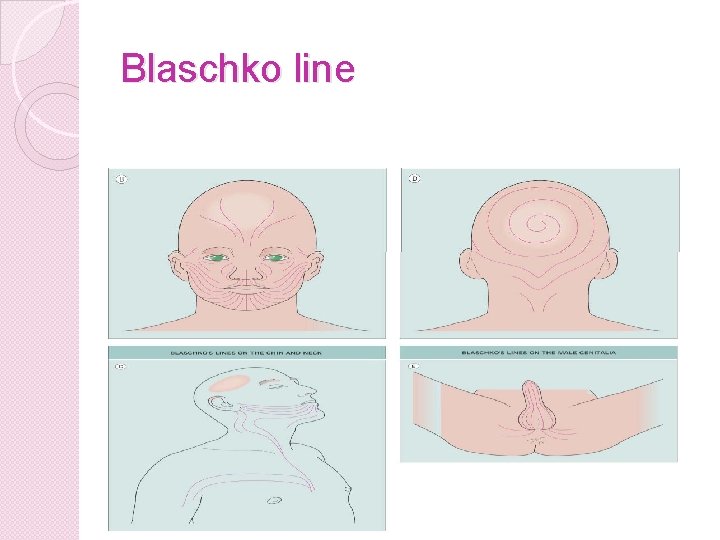 Blaschko line 