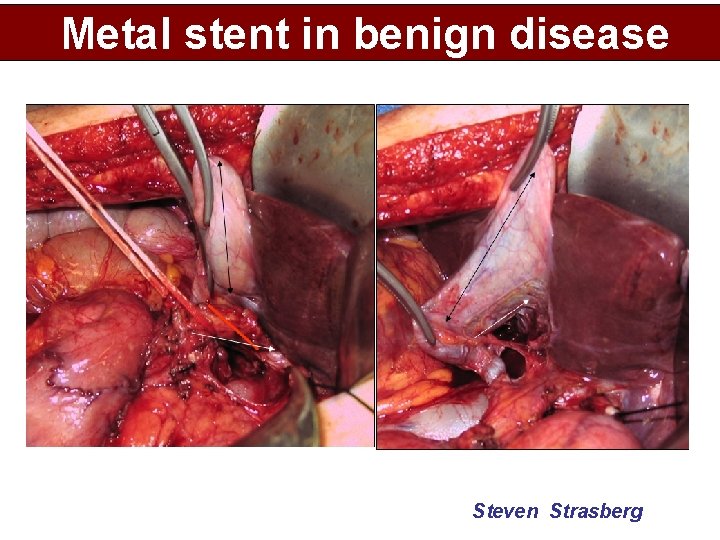 Metal stent in benign disease Steven Strasberg 