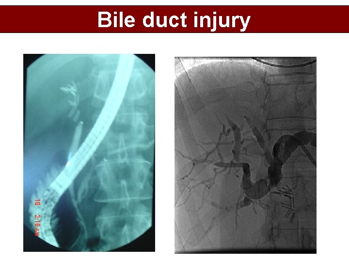 Bile duct injury 