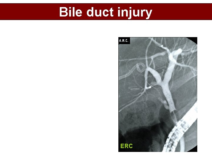 Bile duct injury ERC 