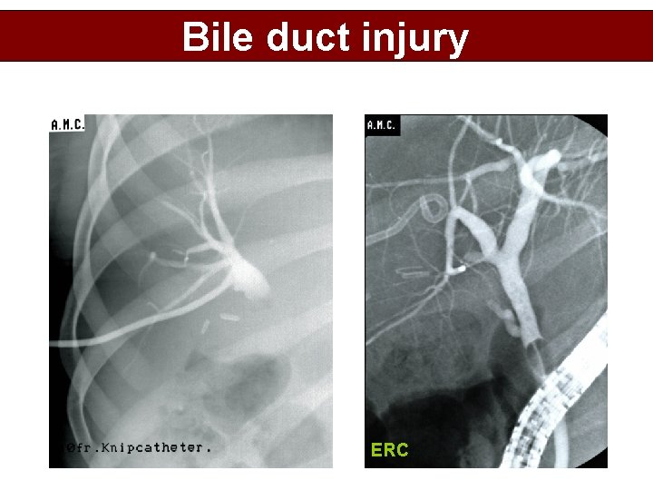 Bile duct injury ERC 