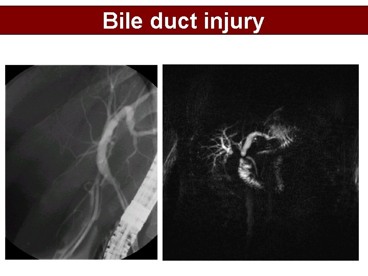 Bile duct injury 