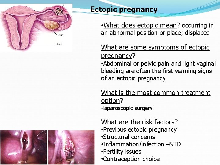 Ectopic pregnancy • What does ectopic mean? occurring in an abnormal position or place;