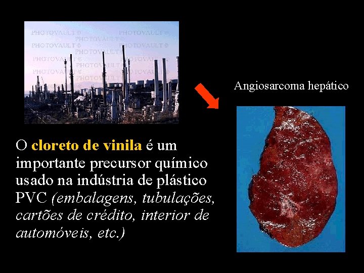 Angiosarcoma hepático O cloreto de vinila é um importante precursor químico usado na indústria