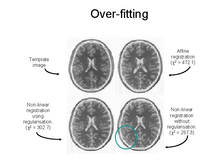 Over-fitting Template image Non-linear registration using regularisation. ( 2 = 302. 7) Affine registration Over-fitting Template image Non-linear registration using regularisation. ( 2 = 302. 7) Affine registration