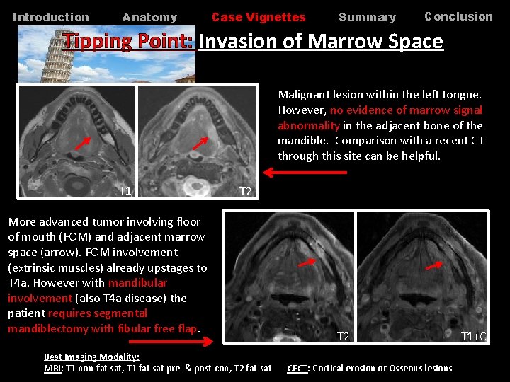 Introduction Anatomy Case Vignettes Summary Conclusion Tipping Point: Invasion of Marrow Space Malignant lesion Introduction Anatomy Case Vignettes Summary Conclusion Tipping Point: Invasion of Marrow Space Malignant lesion