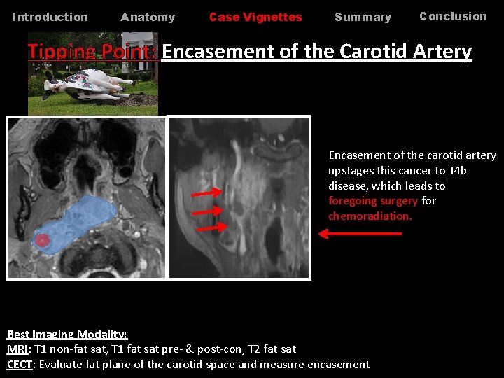 Introduction Anatomy Case Vignettes Summary Conclusion Tipping Point: Encasement of the Carotid Artery Encasement Introduction Anatomy Case Vignettes Summary Conclusion Tipping Point: Encasement of the Carotid Artery Encasement