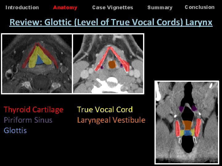 Introduction Anatomy Case Vignettes Summary Conclusion Review: Glottic (Level of True Vocal Cords) Larynx Introduction Anatomy Case Vignettes Summary Conclusion Review: Glottic (Level of True Vocal Cords) Larynx