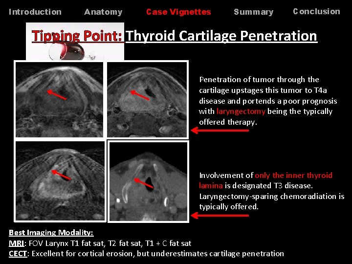 Introduction Anatomy Case Vignettes Summary Conclusion Tipping Point: Thyroid Cartilage Penetration of tumor through Introduction Anatomy Case Vignettes Summary Conclusion Tipping Point: Thyroid Cartilage Penetration of tumor through